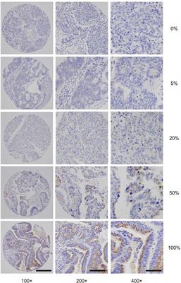 Early-Stage Loss of GALNT6 Predicts Poor Clinical Outcome in Colorectal Cancer